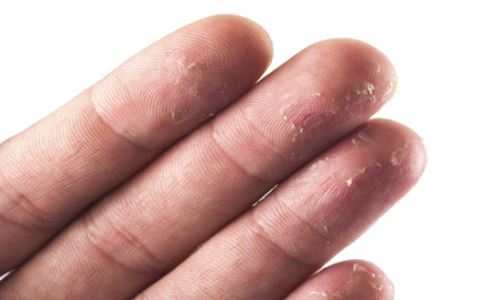 手掌脱皮怎么回事 受6大因素影响(图1) 手掌脱皮怎么回事 手掌脱皮严重吗 手掌脱皮怎么办